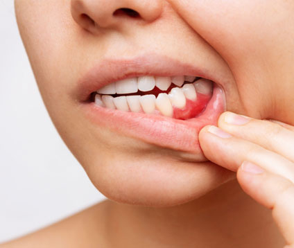 Diş Eti Hastalıkları Tedavisi