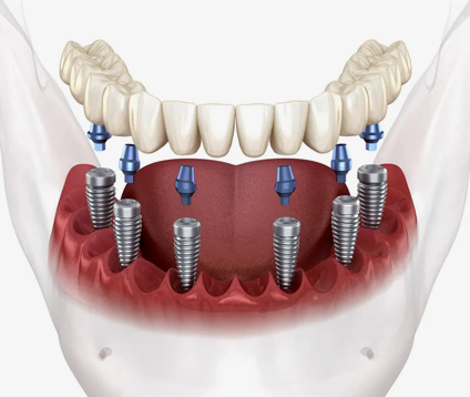 Tüm Çene İmplant Ankara