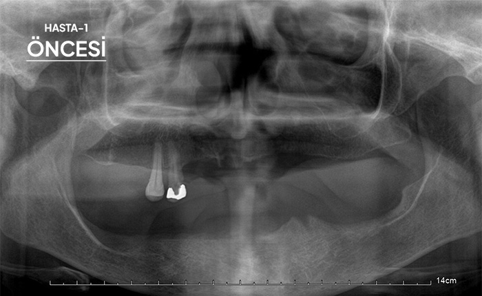 Komple Tüm Çene İmplant 1 Öncesi