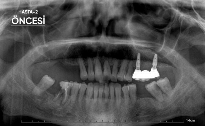 Komple Tüm Çene İmplant 2 Öncesi