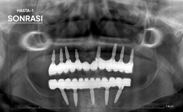 Komple Tüm Çene İmplant 1 Sonrası