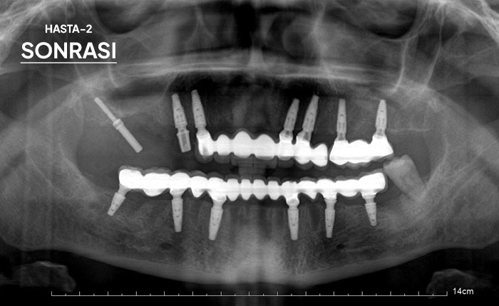 Komple Tüm Çene İmplant 2 Sonrası